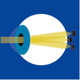 astigmatism_image