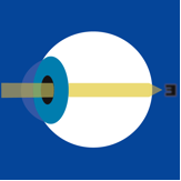 hyperopia_image