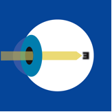 myopia_image