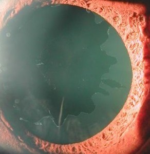pseudoexfoliation