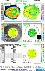 Malitz- Corneal-Topograph-OPD-Nidek-Wavefront-ASA